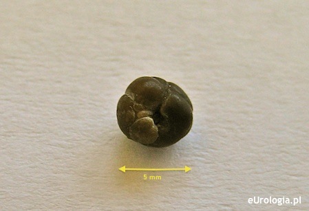 Kamień 5 mm - wydalenie z moczem po kolce nerkowej