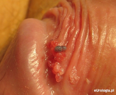 Genital warts: MedlinePlus Medical Encyclopedia