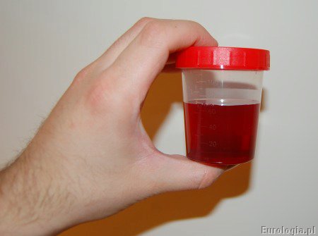 Pojemnik na mocz z próbką moczu - krwiomocz