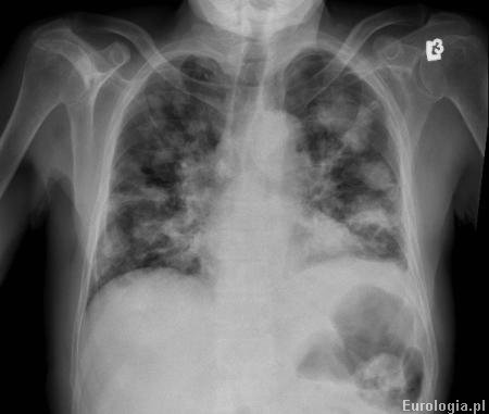 Rak nerki RCC - przerzuty do płuc.