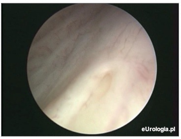 Ujście lewego moczowodu - obraz w cystoskopii