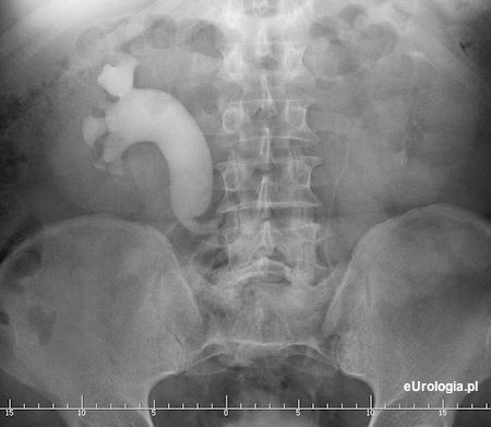 Ureter retrocavalis - moczowód przebiegający za żyłą główną dolną