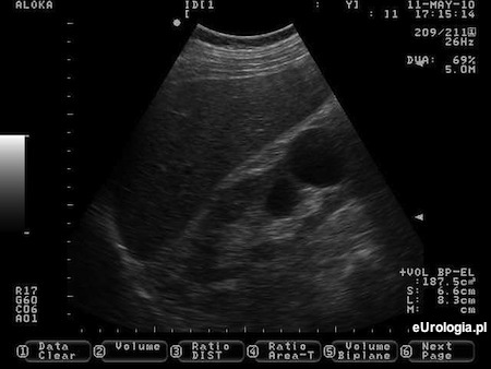 Torbiel prosta nerki w ciąży - USG