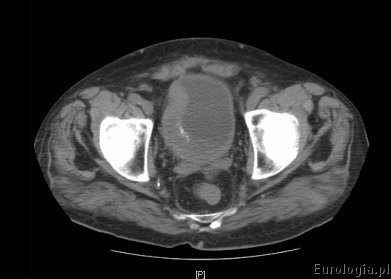 Guz pęcherza moczowego - tomografia
