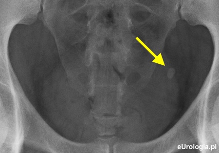 Kamica lewego moczowodu - urografia