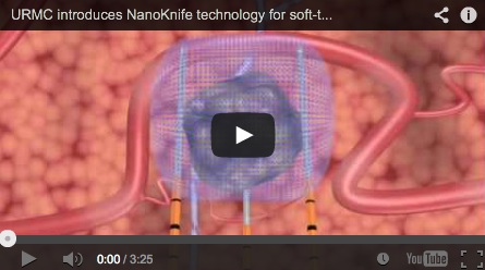 Film poglądowy na temat elektroporacji NanoKnife