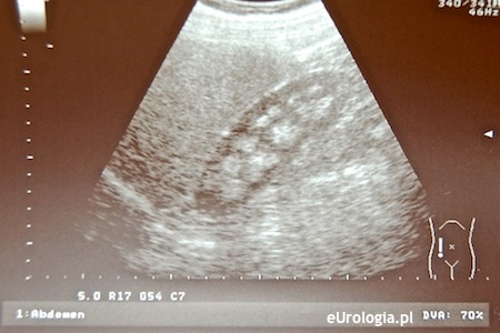 Nefrokalcynoza - obraz USG prawej nerki