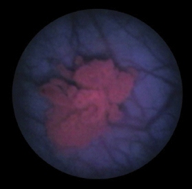 PDD - cystoskopia fluorescencyjna