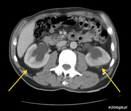 Przerost prostaty - wodonercze obustronne w tomografii