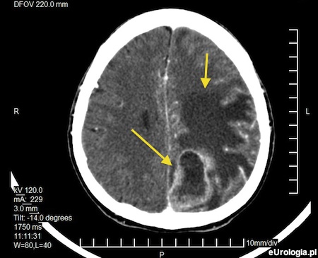 Przerzuty raka gruczołu krokowego do mózgu