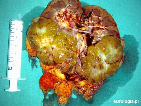 Rak jasnokomórkowy nerki - nerka wycięta z powodu dużego guza