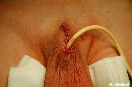 Rak prącia - penektomia subtotalna