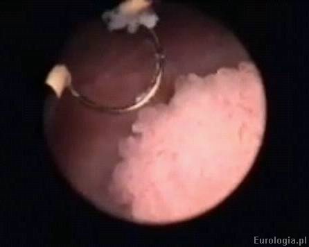 Przezcewkowa resekcja guza pęcherza moczowego - TURT