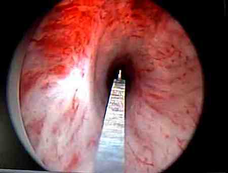 Urtethrotomia optica interna - UOW - uretrotomia