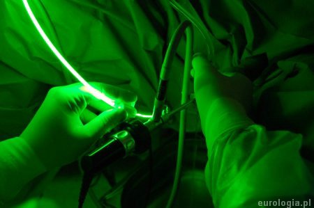 Zielony laser - operacja