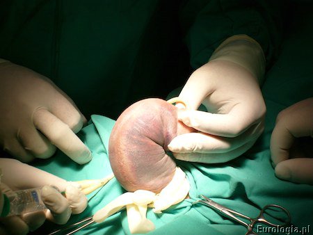 operacja amputacji penisa